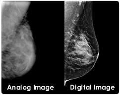 Digital vs Analog Mammogram